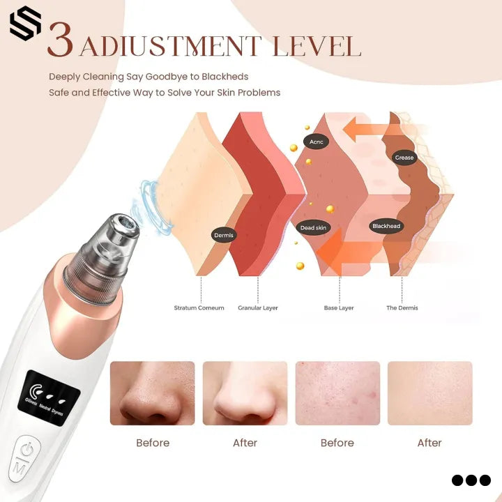 ✨💆 Derma Suction Pore Cleaner 🖤 Powerful Vacuum Blackhead Remover 🌸 | Removes Dirt & Oil for Smooth, Fresh Skin ✨ | Cell Operated 🔋